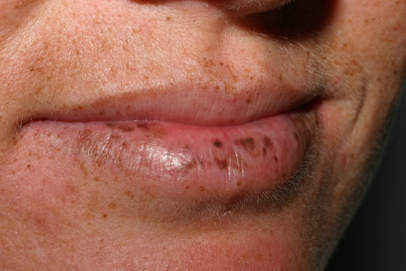 Hội chứng Peutz-Jeghers: Nguyên nhân và cách chẩn đoán 1