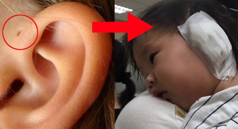 phác đồ điều trị rò luân nhĩ 1