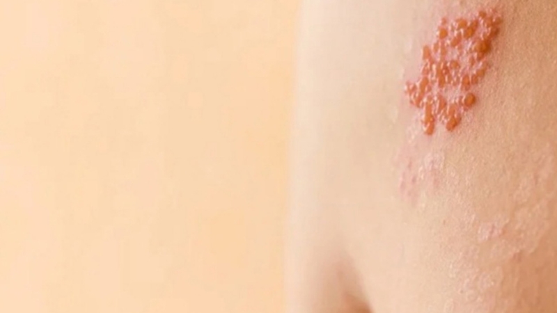 Phân biệt bệnh lý hắc lào zona và cách điều trị 1