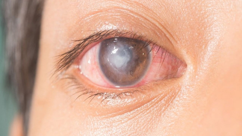 Phân biệt tình trạng viêm kết mạc và viêm giác mạc 2