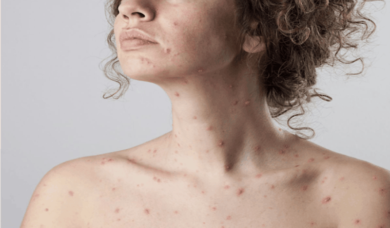 Phat-ban-dang-soi-la-gi-co-nhung-trieu-chung-gi 2.png