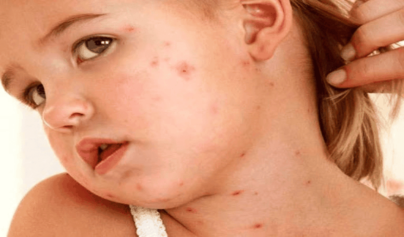 Phat-ban-dang-soi-la-gi-co-nhung-trieu-chung-gi 3.png