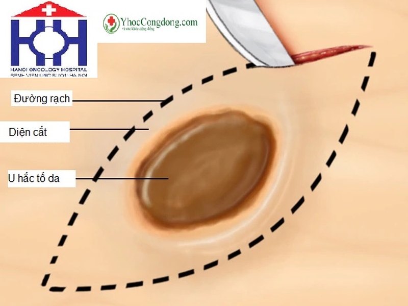 Các phương pháp điều trị ung thư hắc tố2