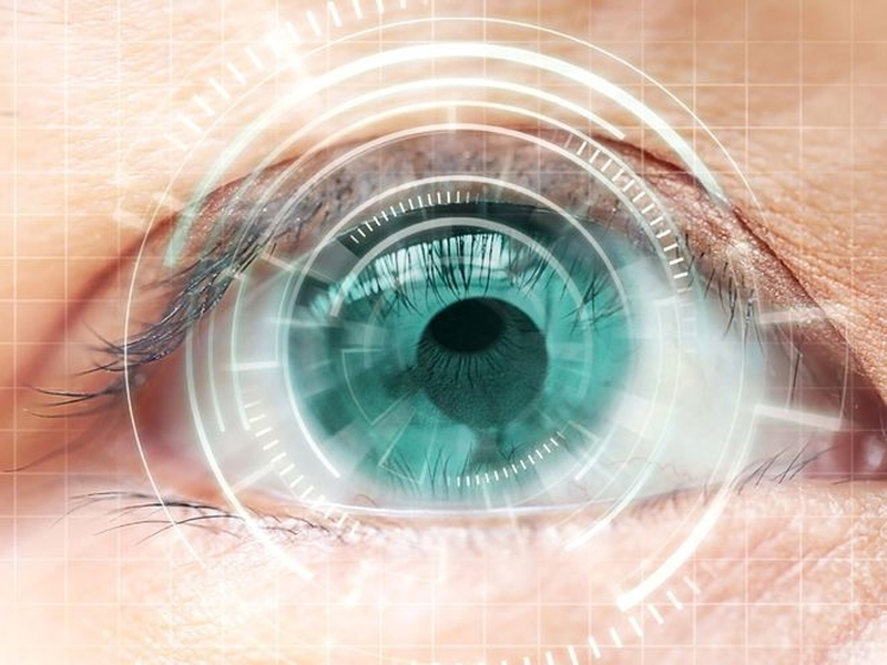 Phẫu thuật femto lasik điều trị mắt cận 2