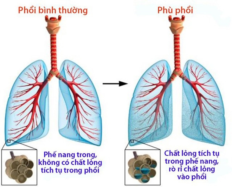 Phù phổi cấp: Cơ chế, chẩn đoán và điều trị 1