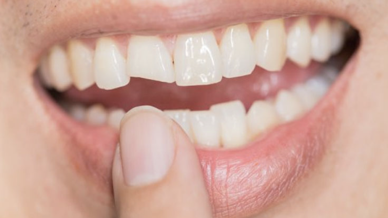 phuc-hinh-rang-la-gi-nhung-dieu-can-biet 2