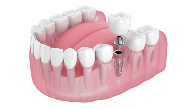 phuc-hinh-rang-la-gi-nhung-dieu-can-biet 3