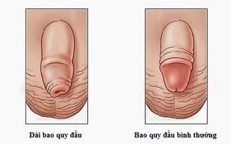 Phương pháp cắt bao quy đầu như thế nào? Lưu ý khi cắt bao quy đầu 1