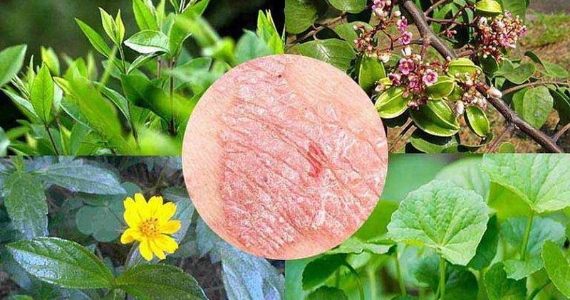 Phương pháp chữa vảy nến bằng tế bào gốc có tốt không? 4.png