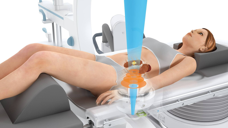 Phương pháp tán sỏi thận bằng công nghệ hiện đại