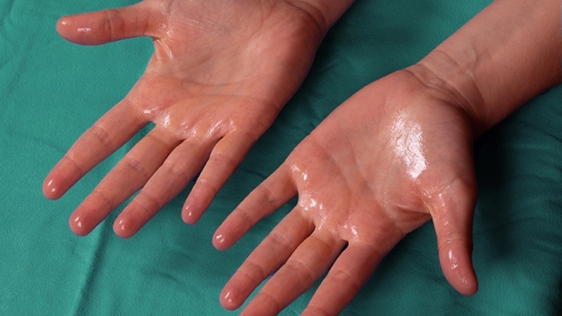 Phương pháp tiêm botox trị mồ hôi tay có hiệu quả không? Lưu ý sau khi tiêm botox 2