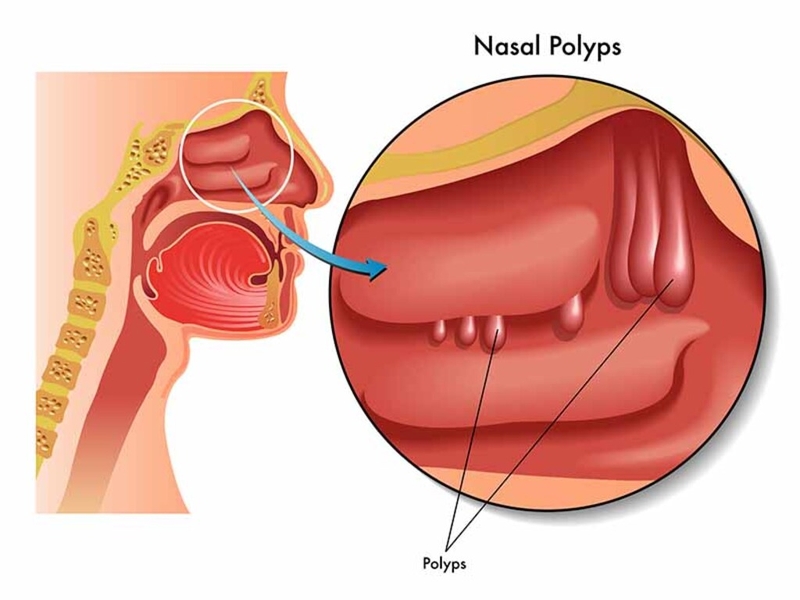 Polyp xoang hàm: Nguyên nhân, triệu chứng, chẩn đoán và cách điều trị 1