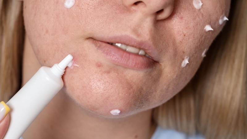 Trong mỹ phẩm, Propanoic acid giúp kiểm soát vi khuẩn và hỗ trợ ngừa mụn