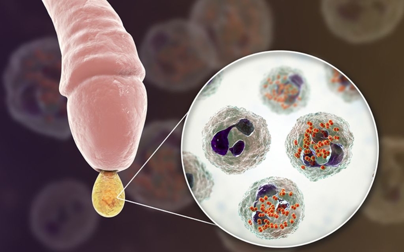 Quy đầu bị đau khi chạm vào nguy hiểm không? Nguyên nhân và biện pháp điều trị 2