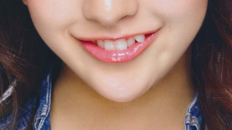 Răng khấp khểnh tạo nét duyên ngầm dễ thương: Có nên trồng răng khểnh không? 1