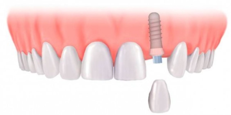 Răng khấp khểnh tạo nét duyên ngầm dễ thương: Có nên trồng răng khểnh không? 4