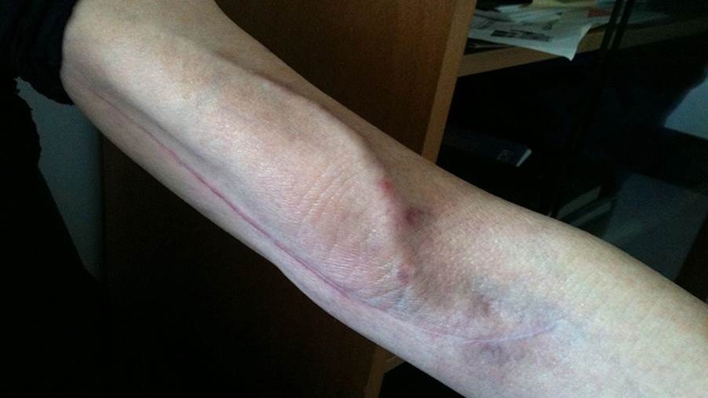 Rò động tĩnh mạch: Nguyên nhân, triệu chứng, phương pháp điều trị 4