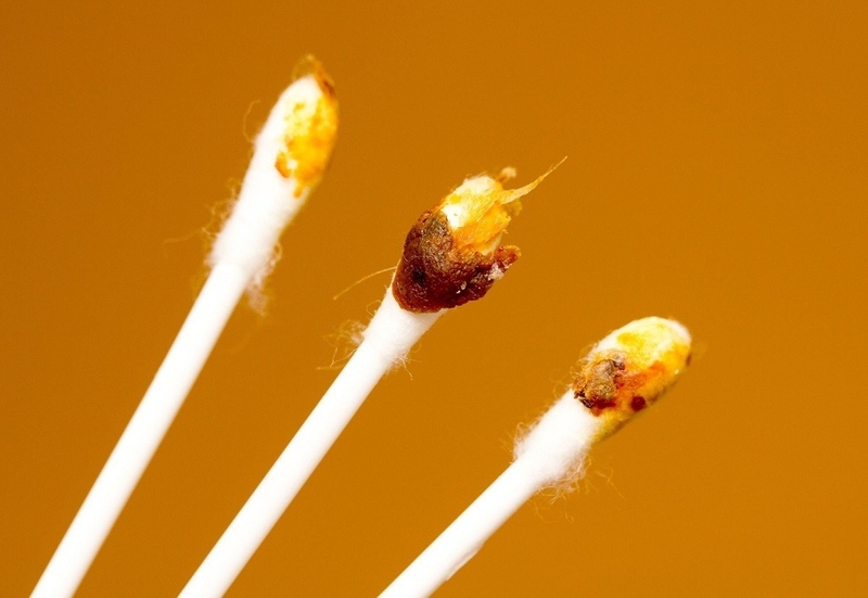 Ráy tai nhiều có tốt không? 2