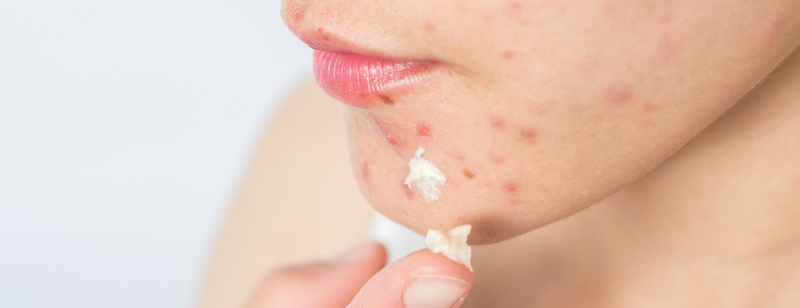 Retin A là thuốc gì? 3