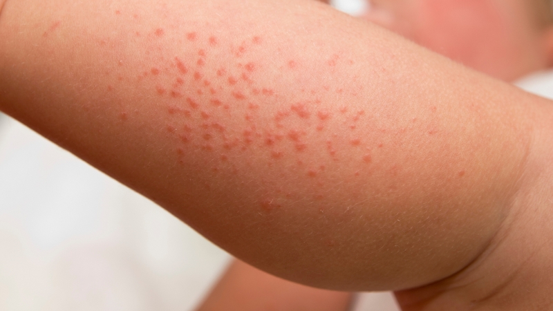 Cách xử lý và phòng ngừa rôm sảy mùa hè hiệu quả 3