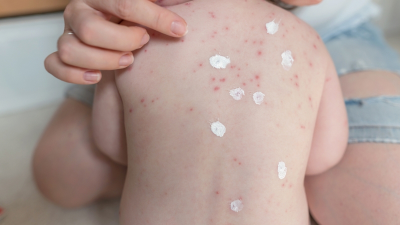 Cách xử lý và phòng ngừa rôm sảy mùa hè hiệu quả 4