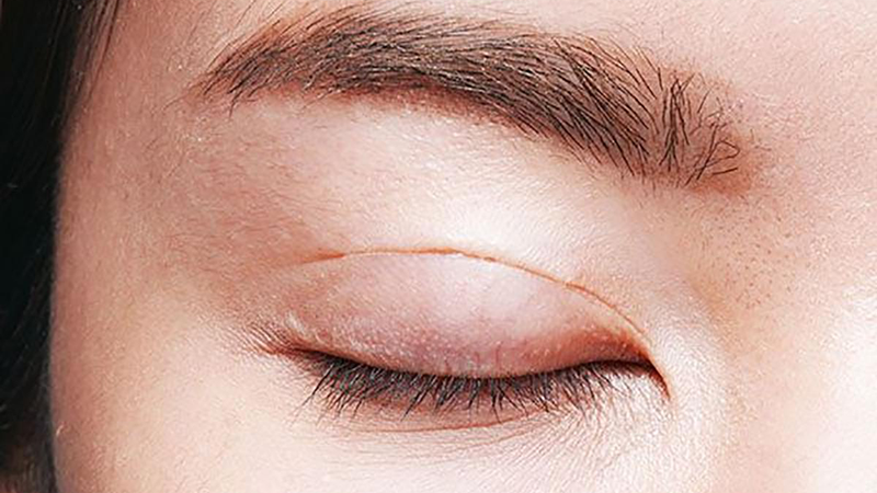 Sau khi thực hiện cắt mí có ăn được thịt vịt không 1