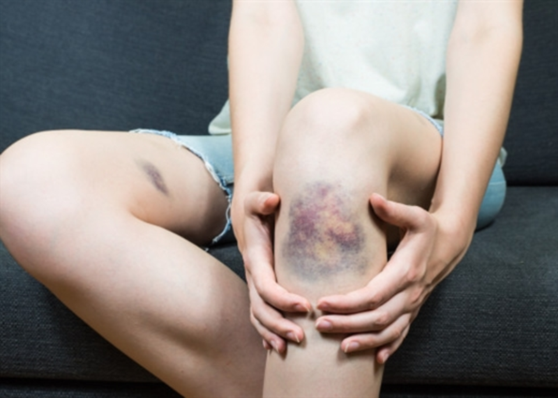 Scorbut là bệnh gì? Scorbut có gây nguy hiểm không? 2