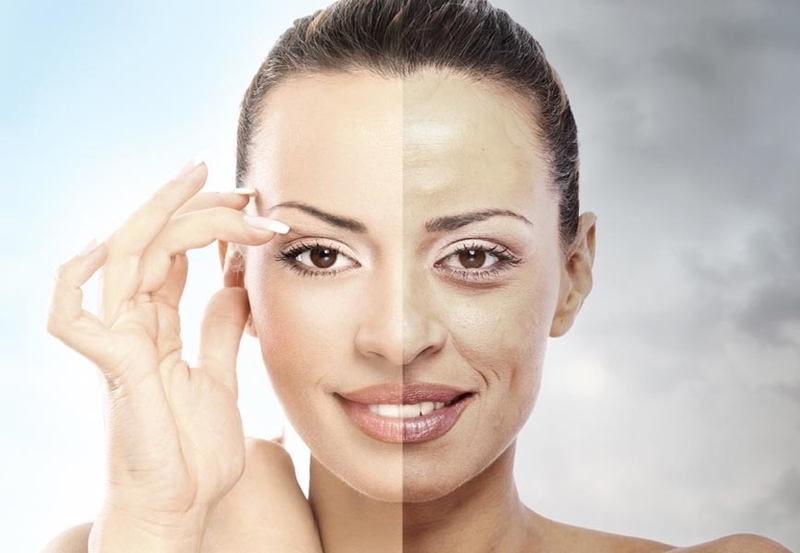 Sẹo do mụn trứng cá 02