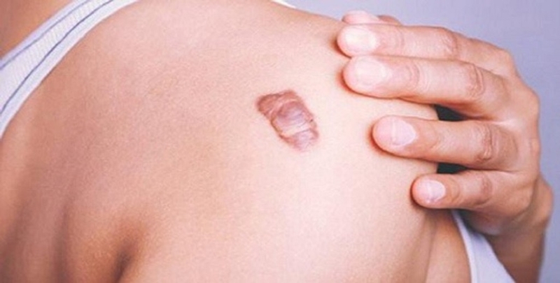 Tìm hiểu sẹo lồi bôi thuốc có hết không? 1