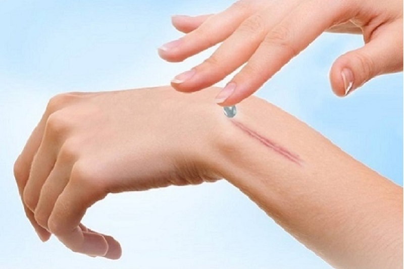 Tìm hiểu sẹo lồi bôi thuốc có hết không? 2