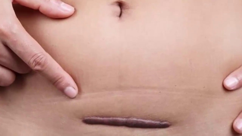 Sẹo lồi có hết được không? 2