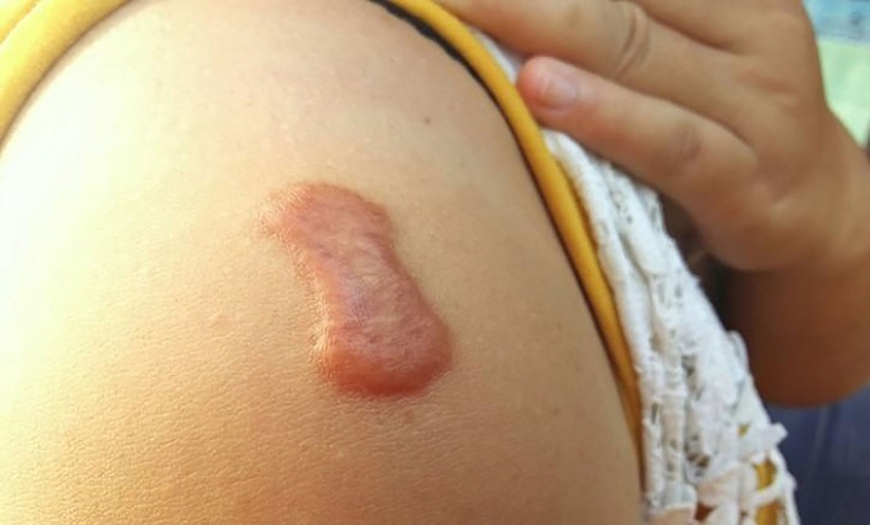 Sẹo lồi lâu năm có trị được không?