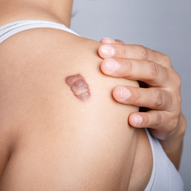 Sẹo lồi ung thư: Nguyên nhân và cách phòng tránh 3