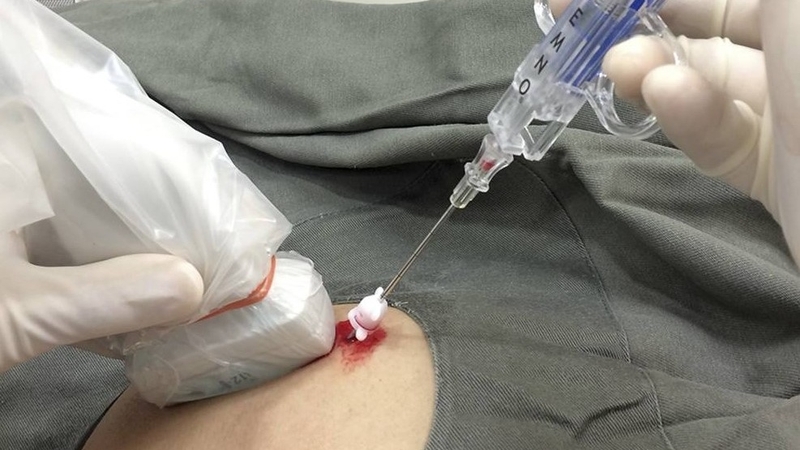 Sinh thiết phát hiện những loại ung thư nào? 3