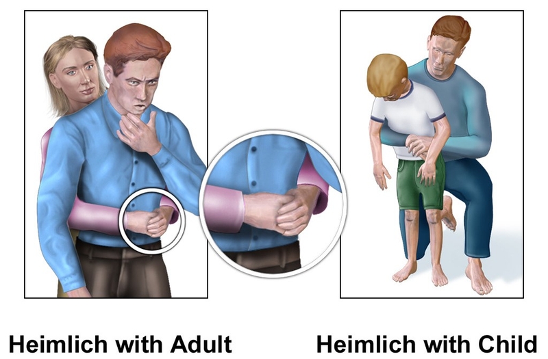 Sơ cứu hóc dị vật ở trẻ 4