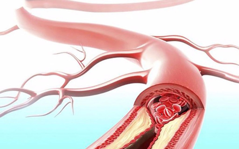 Sơ cứu vết thương chảy máu mao mạch và tĩnh mạch đúng cách và an toàn 1