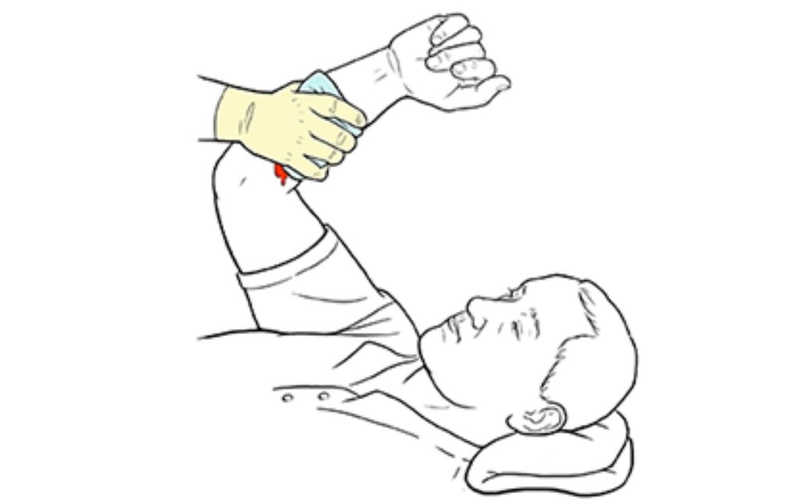 Sơ cứu vết thương chảy máu mao mạch và tĩnh mạch đúng cách, an toàn 4