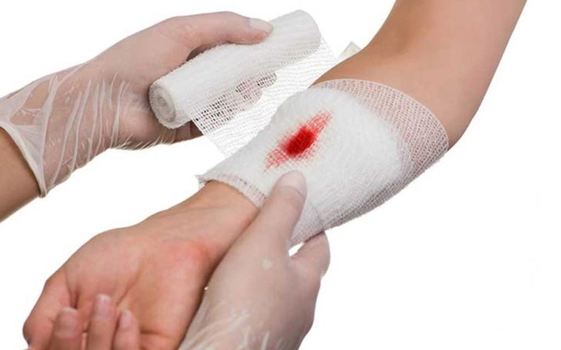 Sơ cứu vết thương chảy máu mao mạch và tĩnh mạch đúng cách và an toàn 5