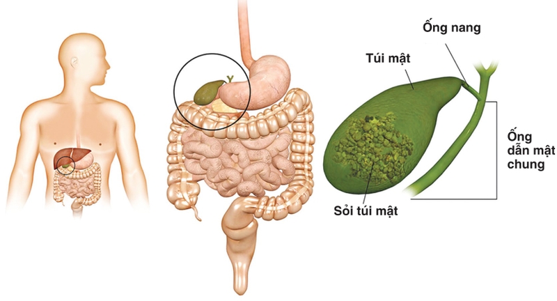 Sốc nhiễm trùng đường mật 01