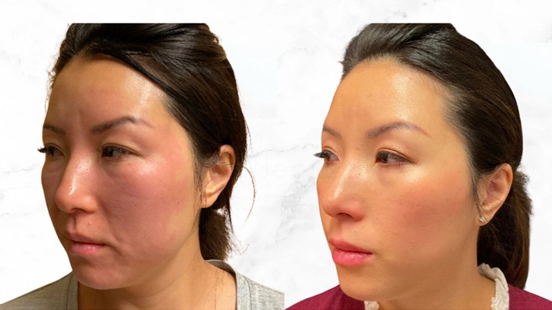 Quy trình làm đẹp da với công nghệ&nbsp;Sofwave nhanh chóng, không xâm lấn