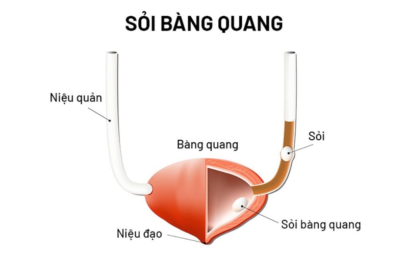 Sỏi bàng quang uống thuốc gì mau khỏi? Những lưu ý khi dùng thuốc 1