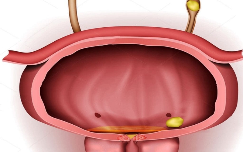 Sỏi bàng quang uống thuốc gì mau khỏi? Những lưu ý khi dùng thuốc 3