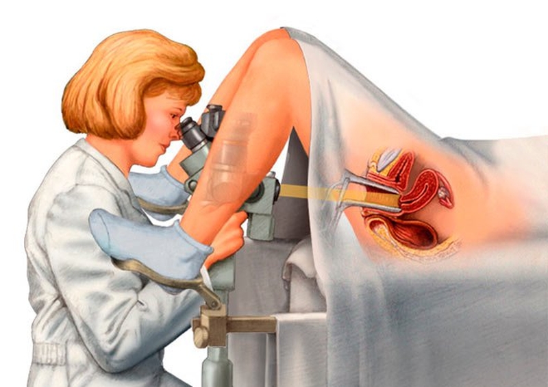 Soi cổ tử cung là gì? Những điều cần chú ý khi soi cổ tử cung 1