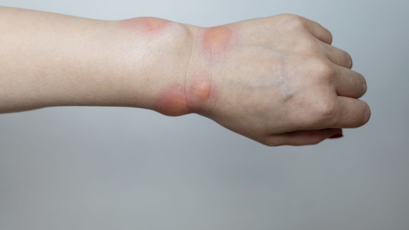 Stanozolol là thuốc được chỉ định cho bệnh phù mạch di truyền