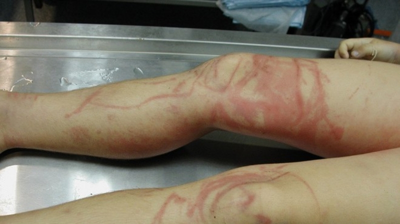 Sứa biển cắn uống thuốc gì? Cách xử lý vết thương khi bị sứa biển cắn 2