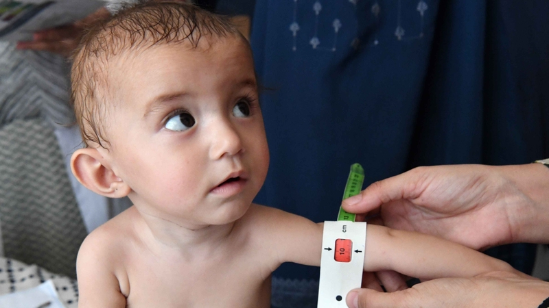 Suy dinh dưỡng cấp độ 3 03