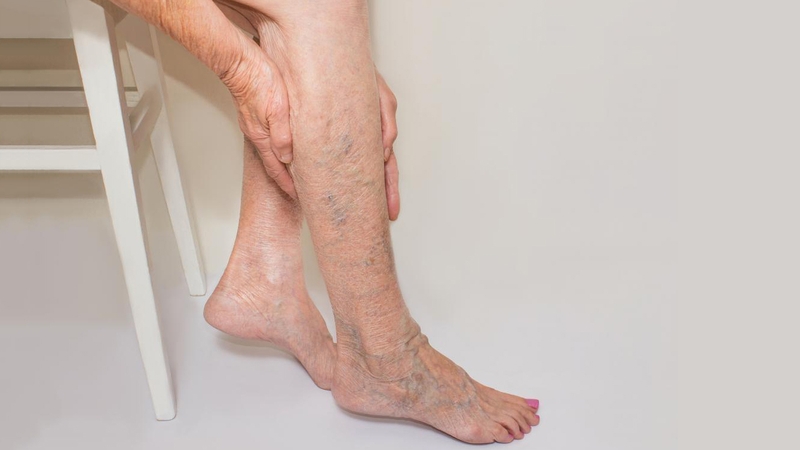 Suy giãn tĩnh mạch chân có nguy hiểm không? Đối tượng nào dễ mắc bệnh 2