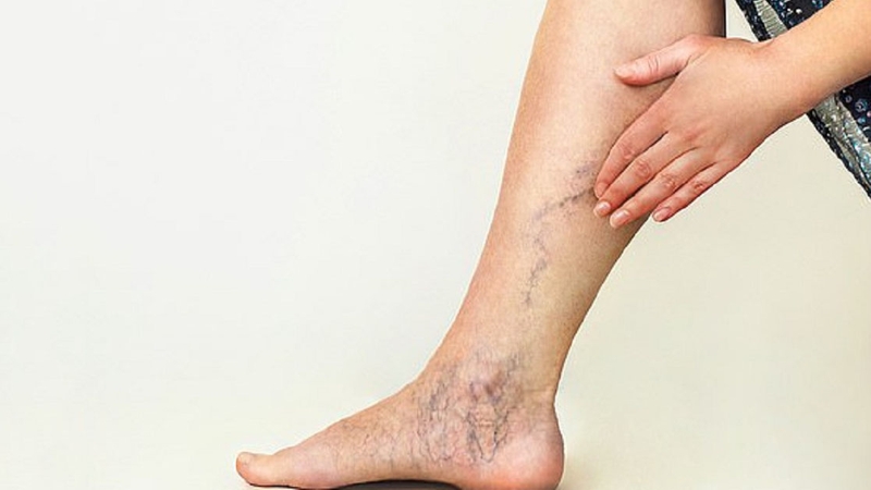 Suy giãn tĩnh mạch chi dưới để lâu có ảnh hưởng nhiều đến sức khỏe không 2