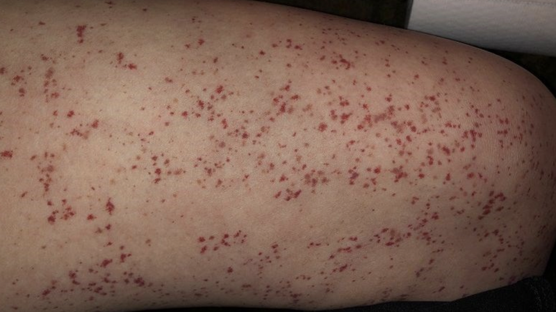 suy-nhuoc-tieu-cau-nguyen-nhan-va-cach-dieu-tri 3