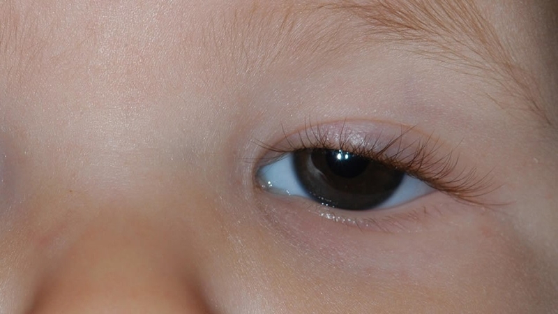 TẬT MẮT NHỎ 4.jpg